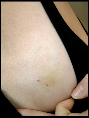 lump in breast from bruise Lump in breast from bruise